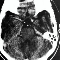 Fig. 1. Tomografia computada con contraste sugiere patología vascular asociada a carótida interna izquierda.