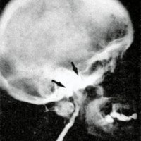 Figura 3c (Caso No. 3): Angiografía postoperatoria inmediata: se ha ocluído la fístula y la carótida interna.