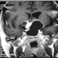 Fig. 12. IRM preoperatorias. Corte coronal.