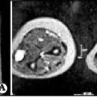 Fig. 2. IRM con contraste de antebrazo izquierdo que evidencia engrosamiento del nervio ulnar.