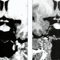 Fig. 2: Caso 9: paciente de 28 años con antecedentes de cefalea crónica. A) IRM con contraste de la primera consulta muestra aumento de tamaño de la glándula y refuerzo tumoral intraxial. B) IRM del seguimiento a 4 años sin modificación del tamaño tumoral, el paciente tampoco presentaba alteraciones endocrinológicas o visuales