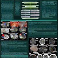 Inclusión de técnicas imagenológicas en la planificación<br /><br />
neuroquirúrgica: integración de equipos multidisciplinarios