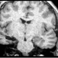 Fig. 28. Cortes coronales postoperatorios con AHS a través de P2.