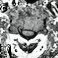 Fig. 2. IRM ponderada en T1. Se aprecia el compromiso del cuerpo vertebral y la proyección al canal medular.