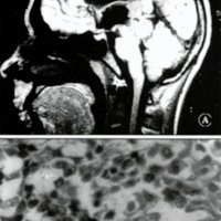 Fig. 3: Paciente de 14 años, de sexo masculino, con germinoma de la región pineal, abordado por vía suboccipital transtentorial. A) RNM. B) Histología.