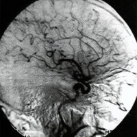 Fig. 4. Angiografía postoperatoria sin evidencias de FAV residual.