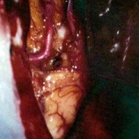 Foto lntraoperatoria Nº 3. Se disecaron ambas arterias callosomarginales y se insinua el fondo del aneurisma.