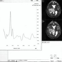 Utilidad de la Resonancia Magnética Espectroscópica en el Estudio de las Lesiones Expansivas Cerebrales