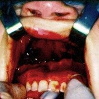 Fig. 13. Completada la maxilotomía Le Fort I, se aplica una ligera presión y se luxa el maxilar hacia abajo.