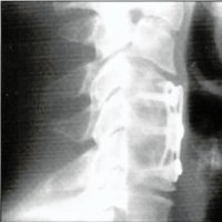Fig. 5. Caso 2: Radiografía simple de perfíl que muestra la placa del abordaje previo y la hipoplasia de las láminas.