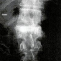 Fig. 6. Vertebroplastia completada. Incidencia frontal. Nivel T12 (fractura osteoporótica)
