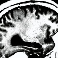 Fig. 2. Corte sagital de una resonancia magnética donde se aprecia el tallo temporal, entre la cisura de Silvio (extremo anterior del surco insular inferior) y el asta temporal del ventrículo lateral.