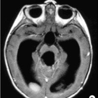 Fig. 2.  B. El mismo paciente en el postoperatorio, donde se observa una resección total.