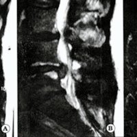 Fig. 4. IRM con gadolinio: A. Prequirúrgica. B. Postoperatoria a los 2 meses C. Postratamiento con 03 a los 6 meses, con desaparición completa de su hernia y sin cambios inflamatorios