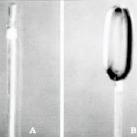 Fig. 2. Modelo de microbalón desperendible montado en catéter. A. Desinflado. B. Inflado (1985)