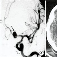 Fig. 6. A. Esquema y angiografía digital de la arteria carótida interna izquierda. Se observa aneurisma de la unión A1 y comunicante anterior del eje posterosuperior. B. TAC donde se observa hematoma intraparenquimatoso a nivel del gyrus rectus.