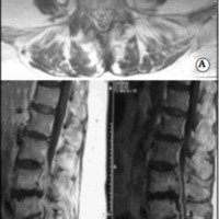 Fig. 2. A. IRM axial que muestra abscesos de psoas bilaterales. B. IRM sagitales que muestran espondilodiscitis L4-L5 con AEE anterior.