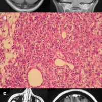 Tratamiento quirúrgico de los hemangioblastomas del sistema nervioso central<br /><br />
