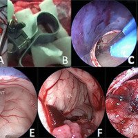 Figura 3: Fotografías intraoperatorias. A) Craneotomía por orificio de trepano ampliado (diámetro aprox. 3cm); B) sistema de fijación; C-G: visión endoscópica en resección de papiloma de plexo coroideo atrial derecho; C y D) resección tumoral (T); E) visión endoscópica del asta temporal ventricular (AT); F) visión endoscópica del cuerpo ventricular (CV); G) corticotomía afrontada con puntos piales.