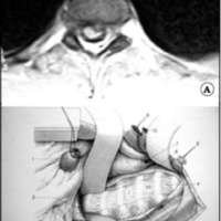 Fig. 6. Hernia de disco T2 T3. A. IRM axial. B. Esquema de abordaje quirúrgico con resección del manubrio esternal.