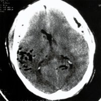 Fig. 1. Tomografia computada que muestra un hematoma extradural bilateral una hora después del trauma, Neumoencéfalo.