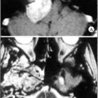Fig. 7. A. IRM preoperatoria mostrando un cordoma con extensión lateral, invadiendo el piso de la fosa media y seno cavernoso, resecado mediante el abordaje a la fosa media. B. IRM postoperatoria mostrando resección total.