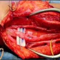 Fig. 3. Imagen intraoperatoria que muestra lesiones ahusadas que afectan los fascículos nerviosos.