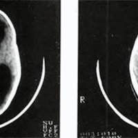 Fig. 2. Papiloma quístico de plexo coroideo. A: prequirúrgico. B: postquirúrgico