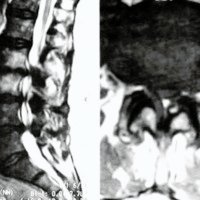 Fig. 1. IRM. Cortes sagital (izquierda) y axial L5 (derecha preoperatorios. Canal lumbar estrecho degenerativo.