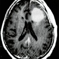 Fig. 2. RMN corte axial T1, Lesión expansiva frontal izquierda, con refuerzo homogéneo post gadolinio, y edema perilesional.