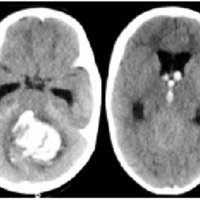 Fig. 1. Tomografía computada donde se observa hematoma cerebeloso con volcado ventricular e hidrocefalia.