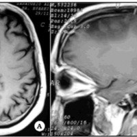 Gliomas cerebrales de bajo grado en el adulto