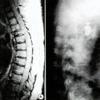 Fig. 2. A) 1RM (corte sagital) de columna dorsal de paciente con metástasis óseas de carcinoma mamario. Aplastamiento vertebral y compresión medular (flecha). B) Radiografia de perfil del postoperatorio de la misma paciente donde se observa el DEVIE en el lugar de la resección del blastoma vertebral (flecha).