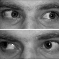 Fig. 2. Caso 1: oftalmoplejía internuclear del ojo izquierdo.