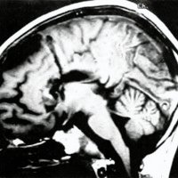 Fig. 5. RM postoperatoria. Paciente de 6 años de edad a quien se le efectuó, bajo guia ECoG wra desconexión del lóbulo frontal.