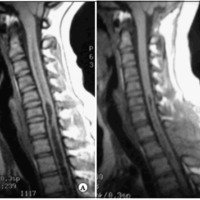 Fig. 3. IRM ponderadas en T1 que muestran la siringomielia (A) y su reducción luego de la DSP (B).
