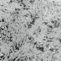 Figura 3. Histología H.E. obj x 10: Tumor fusocelular con empalizadas deltadas por disposición de sus núcleos.