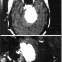 Fig. 1. Resonancia magnética (T1 con contraste) que muestra un gran meningioma petroclival con compresión del tronco cerebral.
