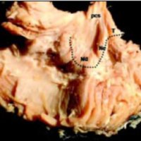 Fig. 20. Disección de los nn. cerebelosos desde la cavidad del IV ventrículo. 