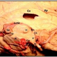 Fig. 1. Corte sagital encefálico donde se evidencian: receso quiasmático (Ro); receso infundibular (Ri); cuerpos mamilares (Cm); adhesión intertalámica (Ci); foramen de Monro (Fm); arteria basilar (Ab); comisura posterior (Cp); mesencéfalo (M); glándula pineal (Gp); vena cerebral interna (Vci); art. posteromedial (AcPM); cuerpo calloso (Cc); art. pericallosa (Ap); septum; comisura anterior (Ca).