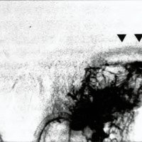 Fig. 2. Fístula dural de seno sigmoideo y laieral izquierdo tipo IIa, con reflujo a seno lateral contralateral (flechas).