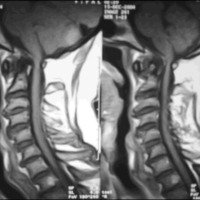 Fig. 3. IRM de columna cervical ponderada en T1.