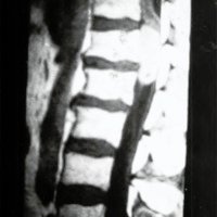 Melanocitoma Espinal. Presentación de un Caso 