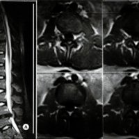 Fig. 3. Caso 3. A. IRM de columna lumbar, corte sagital, en el que se evidencia HNP a nivel L4-5. B. IRM de columna lumbar, cortes axiales, en la que se evidencia HNP posterolateral izquierda a nivel L4-5.