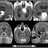 Fig. 8. La resonancia magnética muestra un meningioma petroclival con una amplia inserción dural, removido a través de un abordaje petroso. La resonancia postoperatoria muestra la exéresis total del tumor.