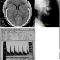 Fig. 7. TC y DTC luego de cirugía descompresiva bilateral. Obsérvese la magnitud de la craniectomía bifrontal y la recuperación del flujo en el DTC.