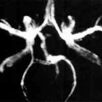 Fig. 1. Corte axial 3D PC: estructura vascular correspondiente a la arteria trigeminal que nace de la porción supraclinoídea de la carótida interna y se dirige al tronco basilar.<br />
