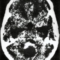 Figura 2. Meduloblastoma quístíco de vermis.