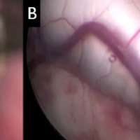 Figura 2: A) Pieza macroscópica intraoperatoria en donde se observa la típica coloración tumoral blanco perlada. B) Asistencia endoscópica para completar exéresis quirúrgica logrando descomprimir el foramen de Monro.