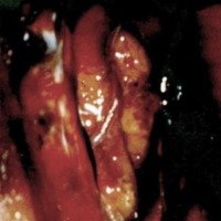 Foto intraoperatoria Nº 2. Se observa la arteria callosomarginal y se comienza la disección de la artería pericallosa.